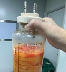 兴安盟水动力吸脂手术要做多久？